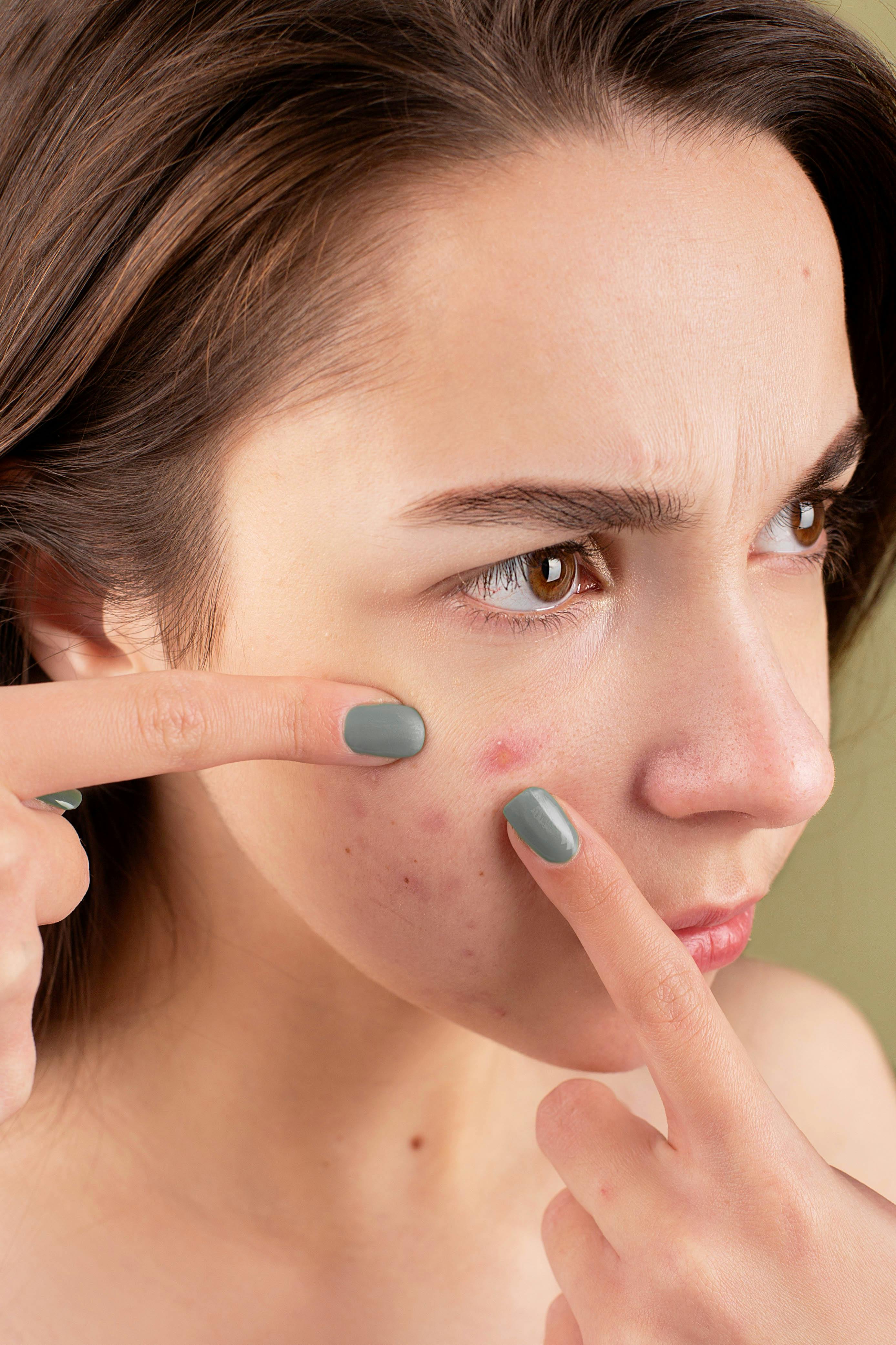 Acne and Pimples: Causes, Prevention, and the Right Care for Clear Skin